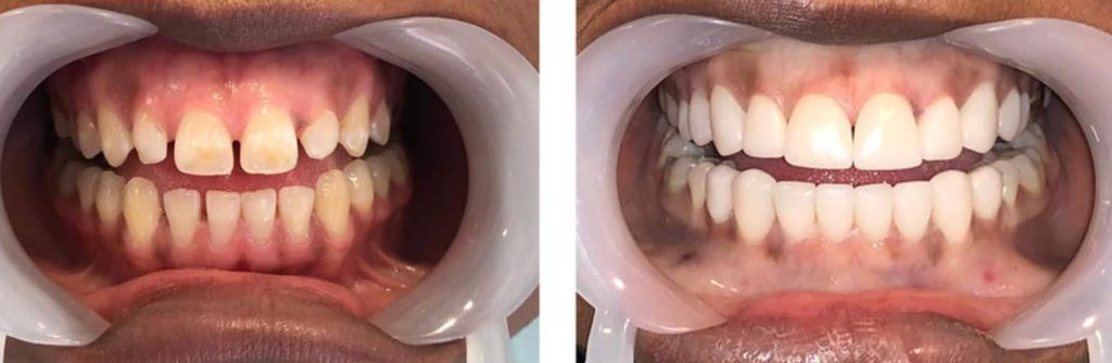Dental veneers results