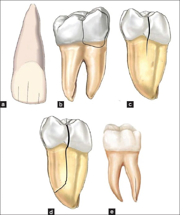 types of cracked teeth