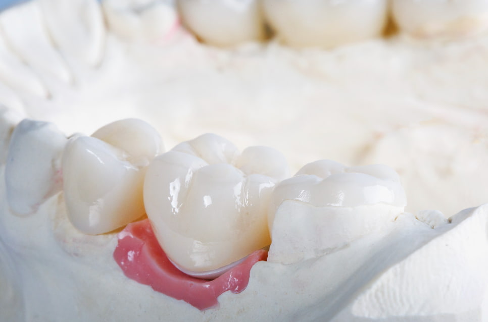Dental Cantilever Bridge: Suitability & Cost | Longevita