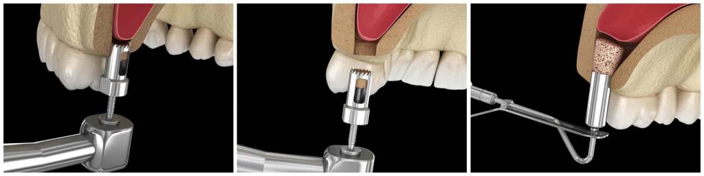 Sinus lift procedure