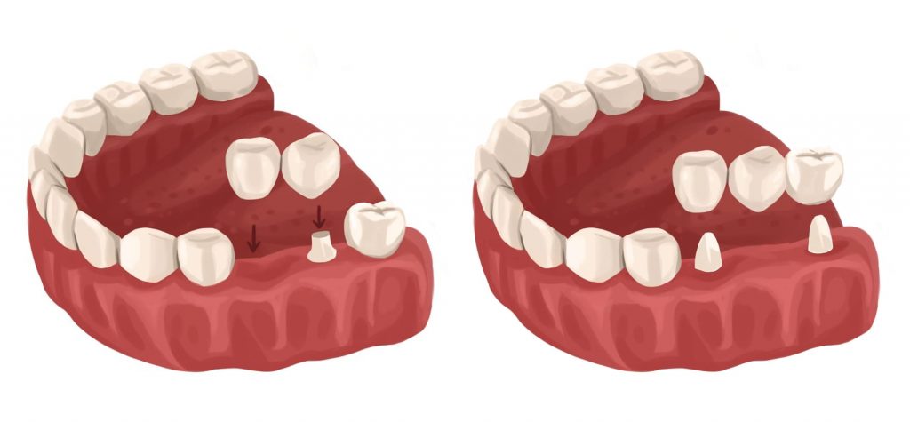 dental cantilever bridge vs traditional bridge