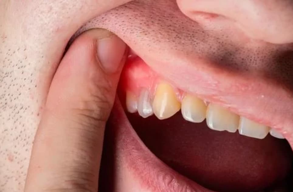 gum problem