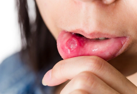 mouth ulcer