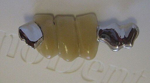 3 tooth Maryland dental bridge