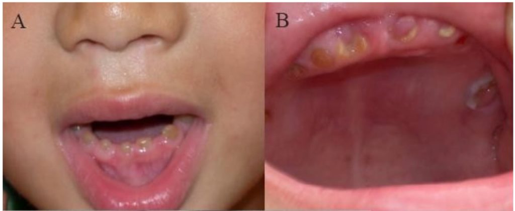 dentinogenesis imperfecta
