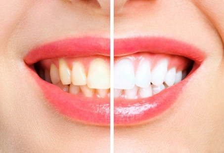 teeth whitening difference