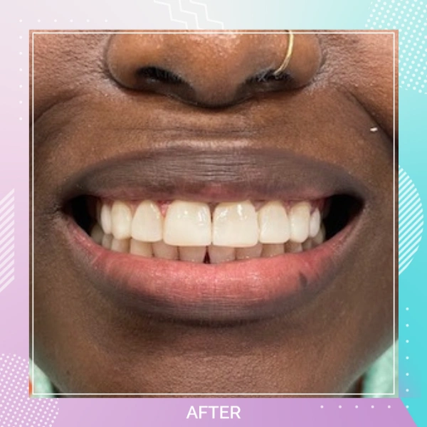 Composite Bonding patient 1 A 1