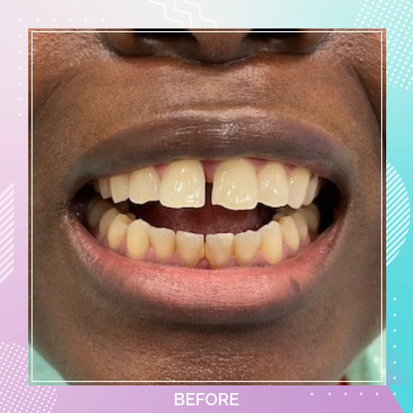 Composite Bonding patient 1 B 1