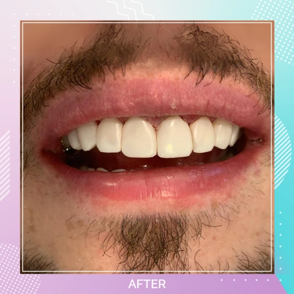 Composite Bonding patient 2 A 1