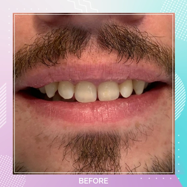 Composite Bonding patient 2 B 1
