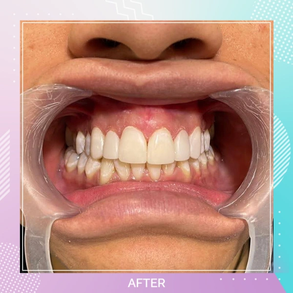 Composite Bonding patient 4 A 1