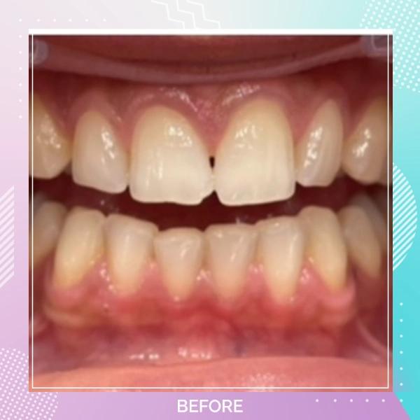 Composite Bonding patient 5 B 1