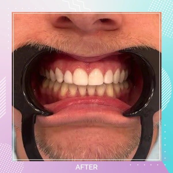 Composite Bonding patient 6 A 1