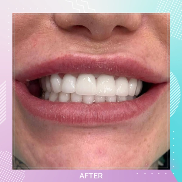 Dental Crowns patient 1 A 1