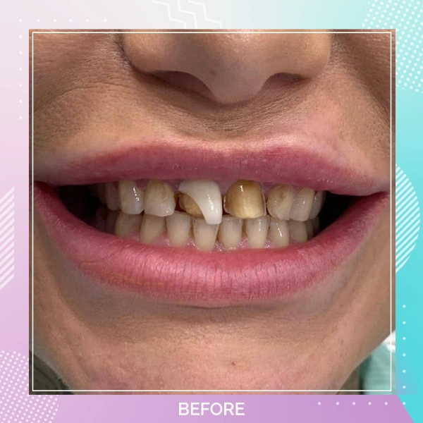 Dental Crowns patient 1 B 1