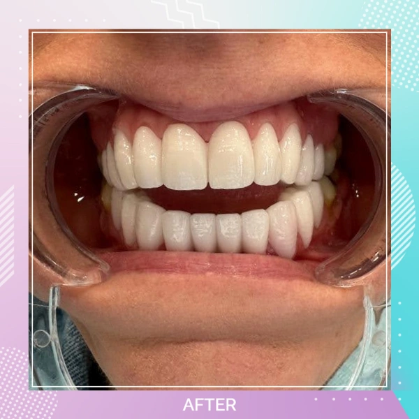 Dental Crowns patient 11 A 1