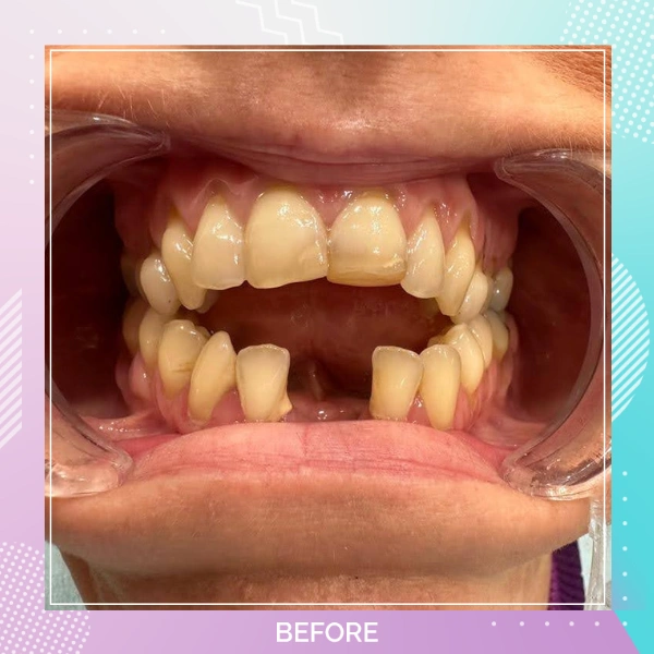 Dental Crowns patient 11 B 1