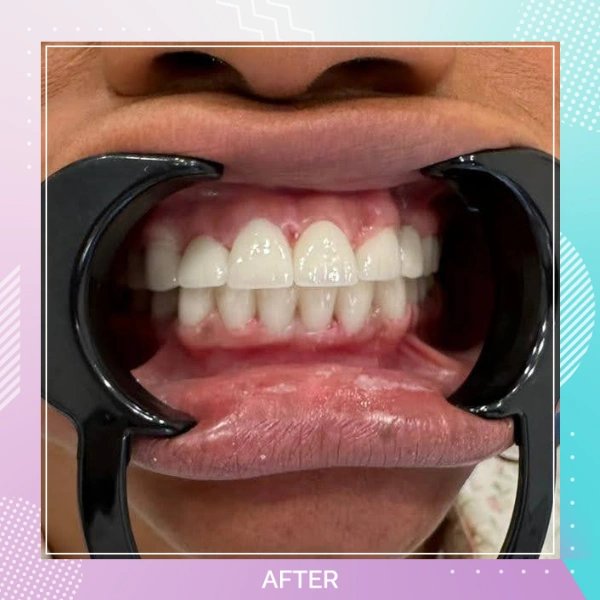 Dental Crowns patient 12 A 1