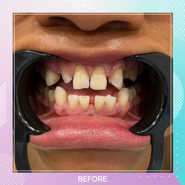Dental Crowns patient 12 B 1