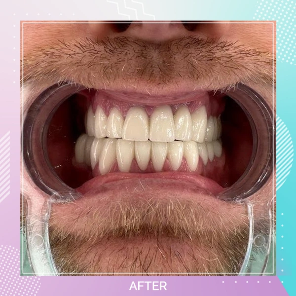 Dental Crowns patient 13 A Hollywood smile