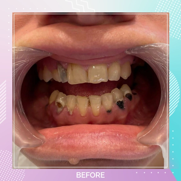 Dental Crowns patient 14 B Hollywood smile