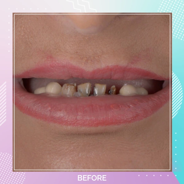 Dental Crowns patient 15 B 1