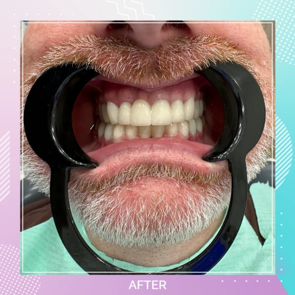 Dental Crowns patient 16 A 1