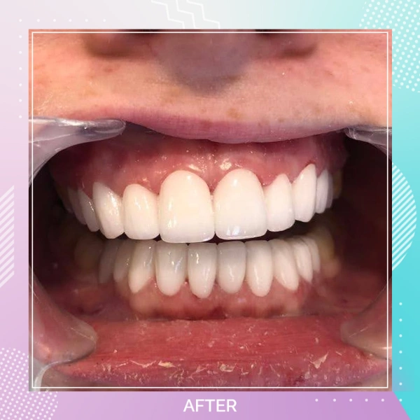 Dental Crowns patient 3 A 1