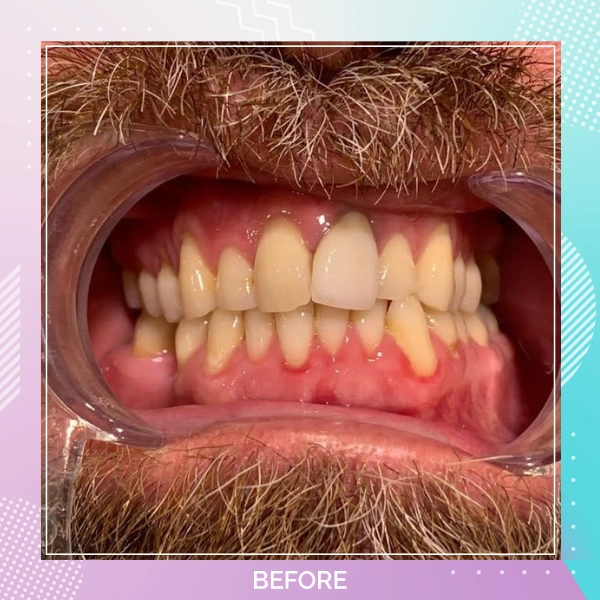 Dental Crowns patient 5 B 1