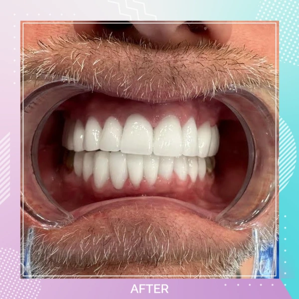 Dental Crowns patient 6 A 1