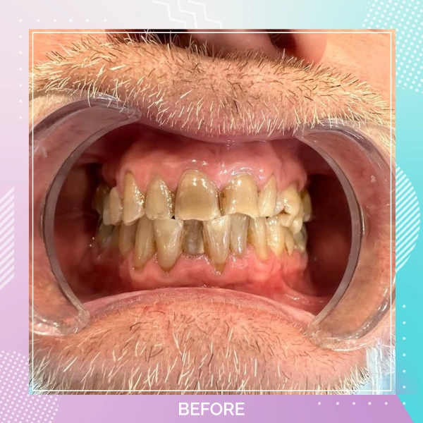 Dental Crowns patient 6 B 1