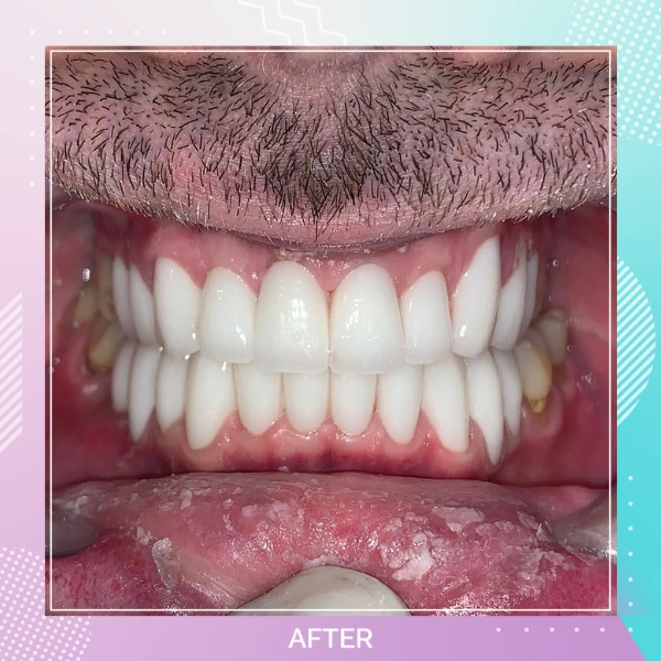Dental Crowns patient 7 A 1