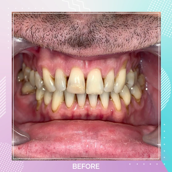 Dental Crowns patient 7 B 1