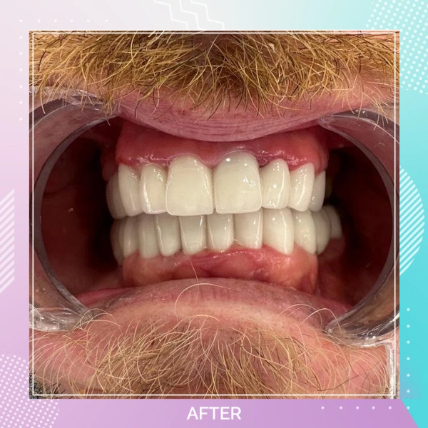 Dental Crowns patient 8 A 1