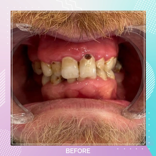 Dental Crowns patient 8 B 1