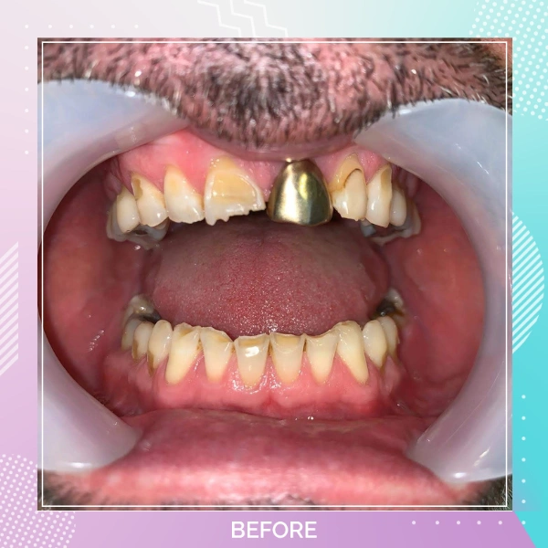 Dental Crowns patient 9 B 1