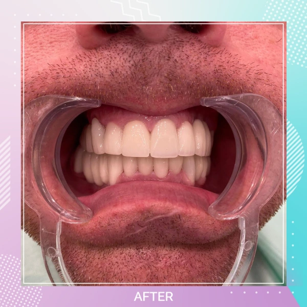 Dental Implants patient A 1