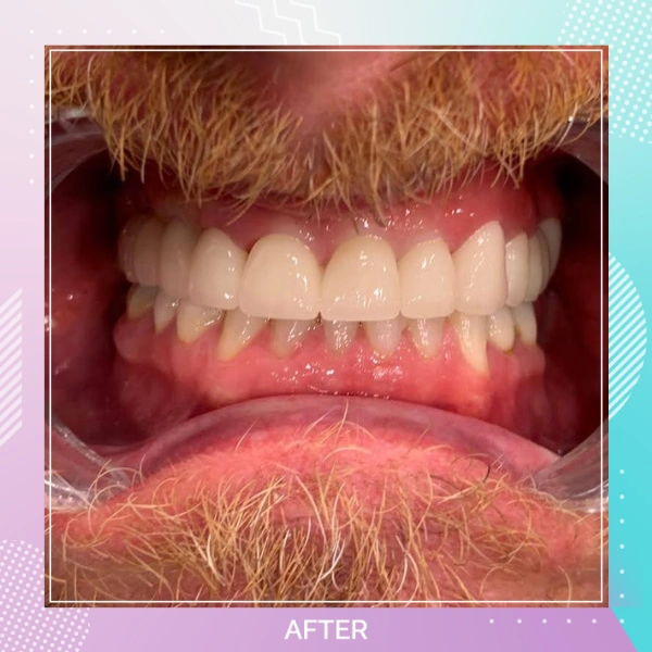 Dental Implants patient A 10