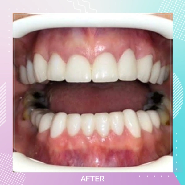 Dental Implants patient A 5