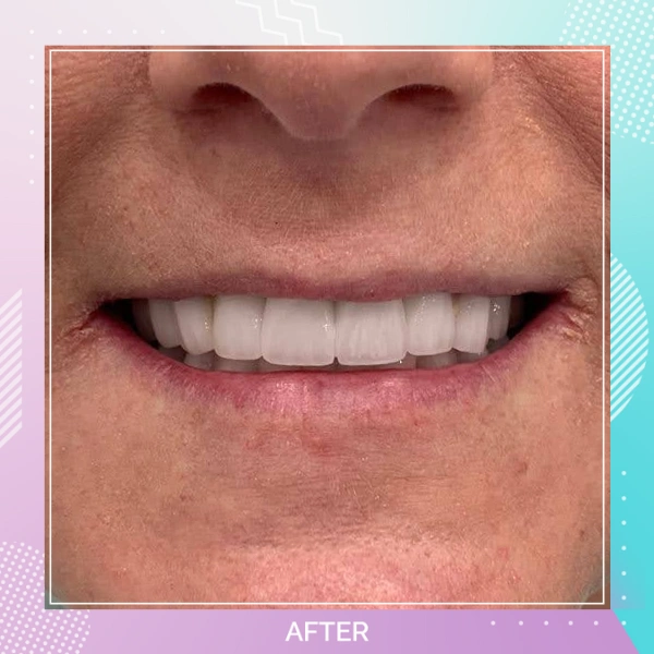 Dental Implants patient A 9