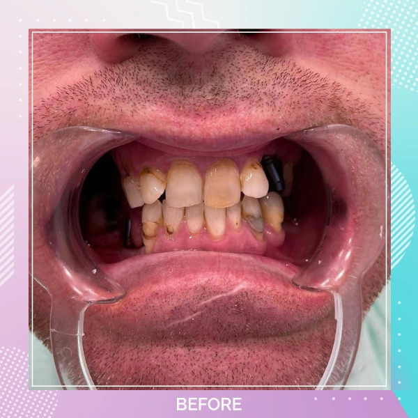 Dental Implants patient B 1