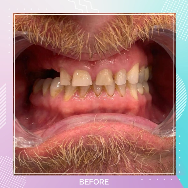 Dental Implants patient B 10