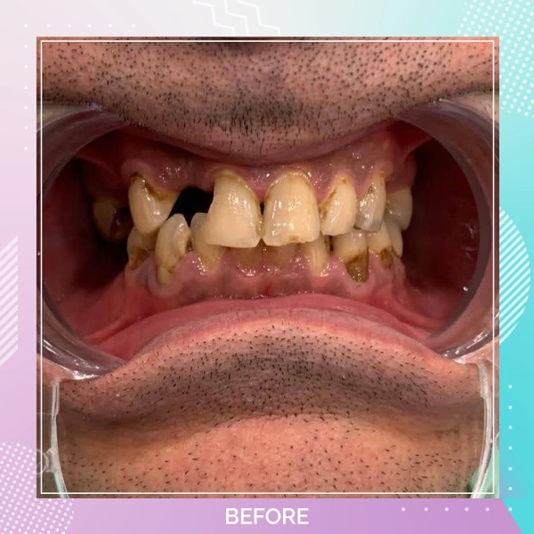 Dental Implants patient B 3