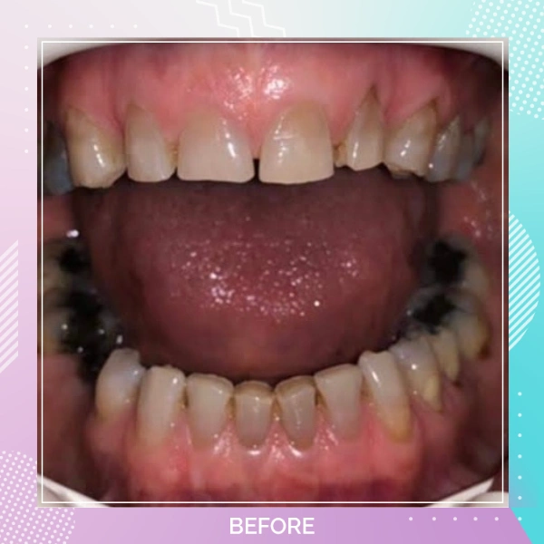 Dental Implants patient B 5