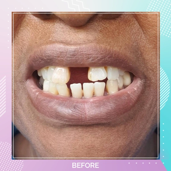 Dental Implants patient B 6