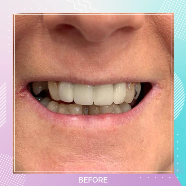 Dental Implants patient B 9