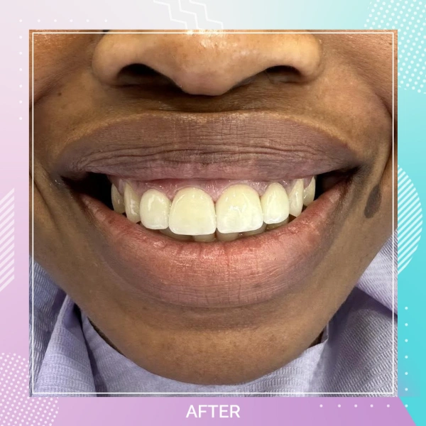 Dental Veneers patient 1 A 1