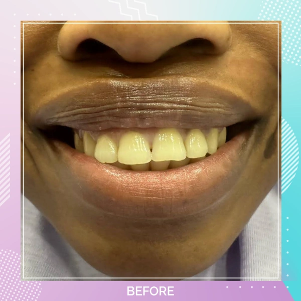 Dental Veneers patient 1 B 1