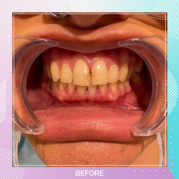 Dental Veneers patient 2 B 1