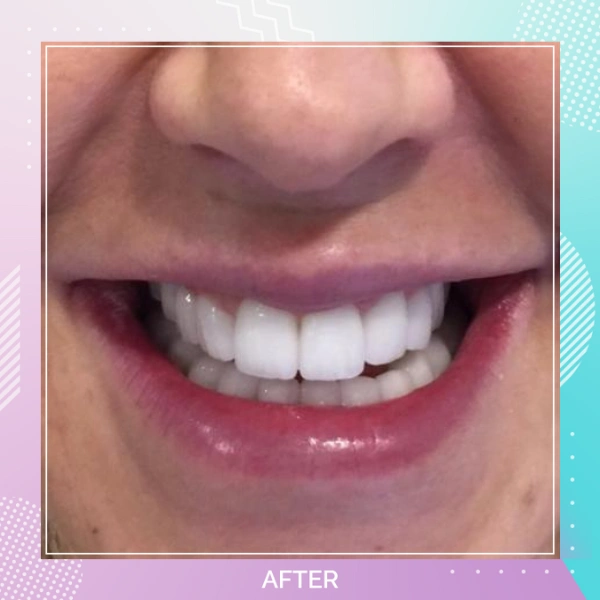 Dental Veneers patient 3 A 1